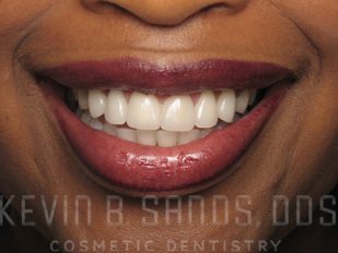 Periodontal Care in Beverly Hills, CA After Image 3