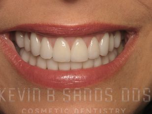 Periodontal Care in Beverly Hills, CA After Image 1