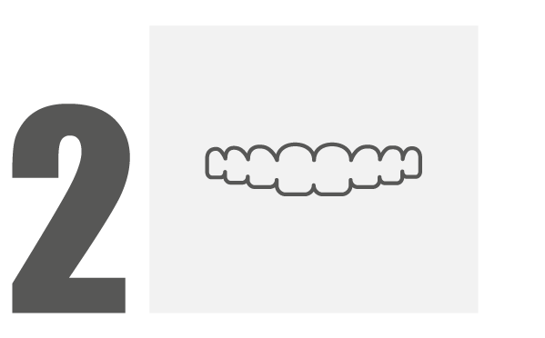 Temporary Veneers