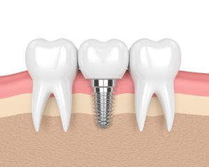3D image of dental implant
