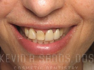 Sedation Dentistry in Beverly Hills, CA Before Image 3