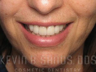 Sedation Dentistry in Beverly Hills, CA After Image 3