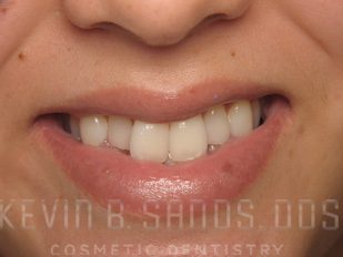 ZOOM! Teeth Whitening in Beverly Hills, CA Before Image 2
