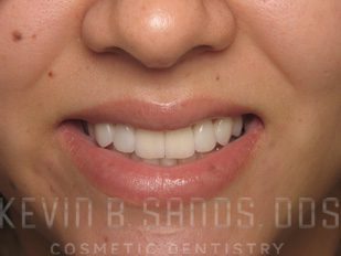 ZOOM! Teeth Whitening in Beverly Hills, CA After Image 2