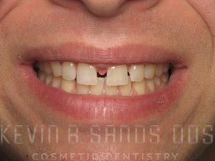 Sedation Dentistry in Beverly Hills, CA Before Image 2