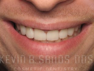 Sedation Dentistry in Beverly Hills, CA After Image 2