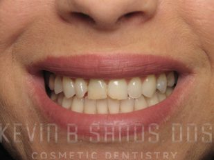 Sedation Dentistry in Beverly Hills, CA Before Image 1