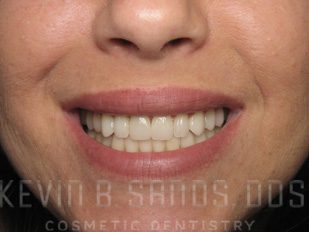 Sedation Dentistry in Beverly Hills, CA After Image 1